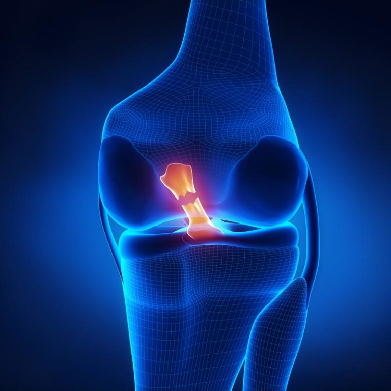 ACL Rupture - Lyndon Bradley