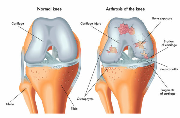 arthritis of the knee