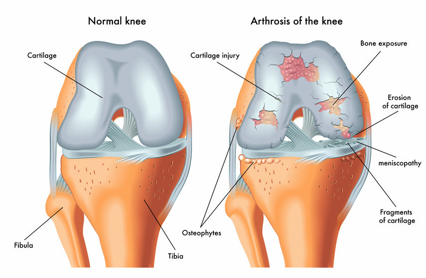 Cartilage Treatments Lyndon Bradley