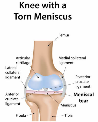 medial meniscus tear